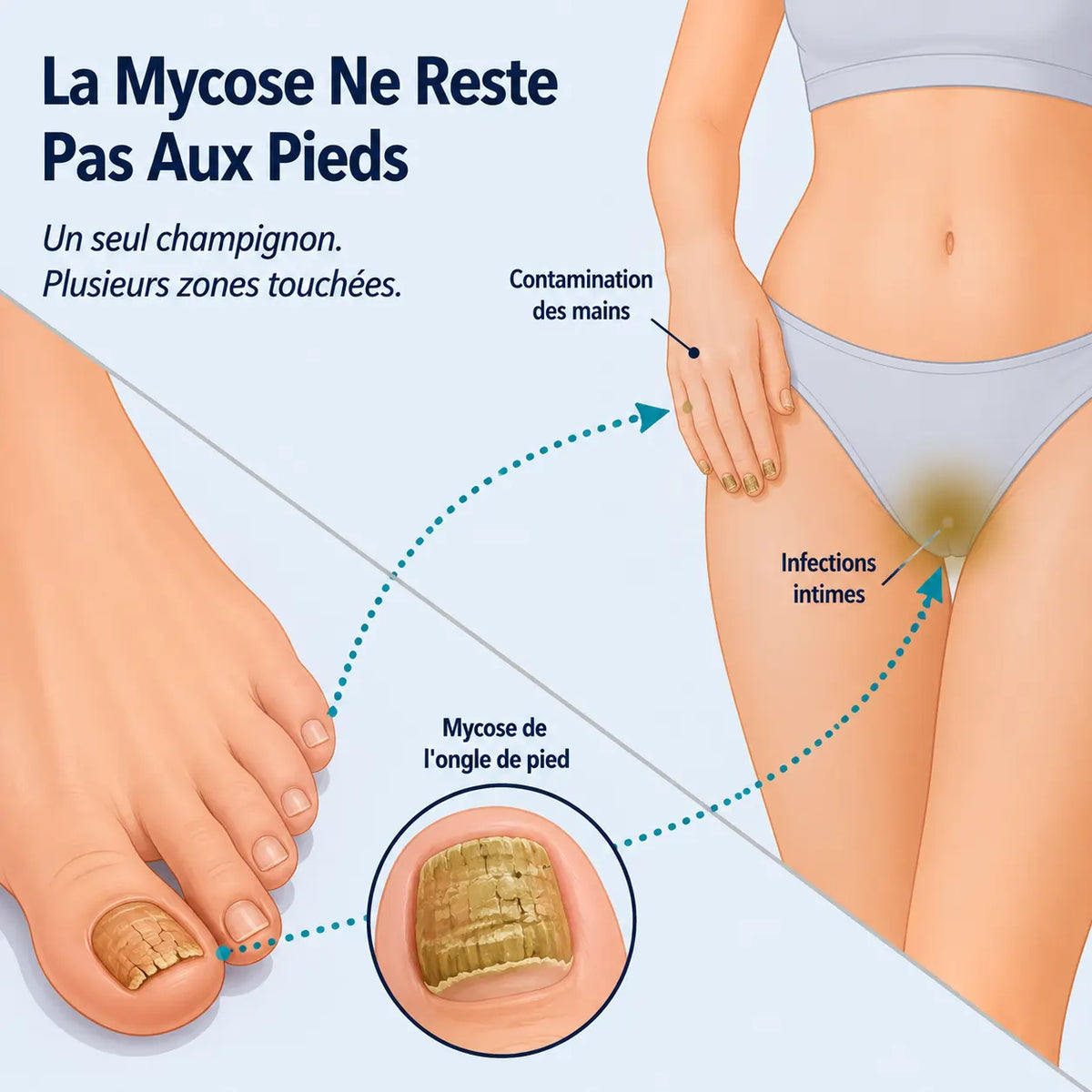 Anti-Fongix | HUILE D'ORIGAN & DE NIGELLE – ÉLIMINE LA MYCOSE ET LES INFECTIONS