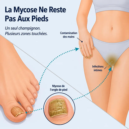 Anti-Fongix | HUILE D'ORIGAN & DE NIGELLE – ÉLIMINE LA MYCOSE ET LES INFECTIONS